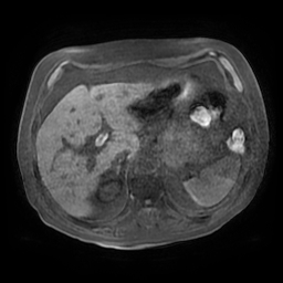 Acute cholecystitis complicated by pylephlebitis (Radiopaedia 65782-74915 Axial T1 fat sat 38).jpg