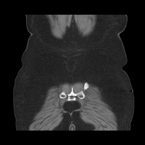 Acute cholecystitis with tensile fundus sign (Radiopaedia 71394-81723 Coronal non-contrast 108).jpg