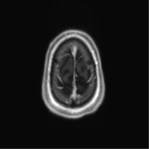 Acute disseminated encephalomyelitis (ADEM) (Radiopaedia 65319-74350 Axial T1 C+ 62).png