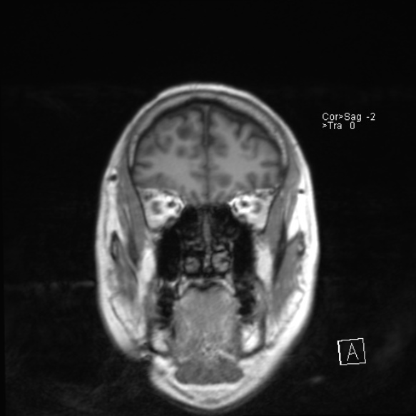 File:Acute disseminated encephalomyelitis (Radiopaedia 37253-39033 Coronal T1 7).jpg