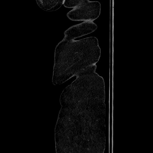 Acute diverticulitis - transverse colon (Radiopaedia 87063-103327 Sagittal C+ portal venous phase 25).jpg