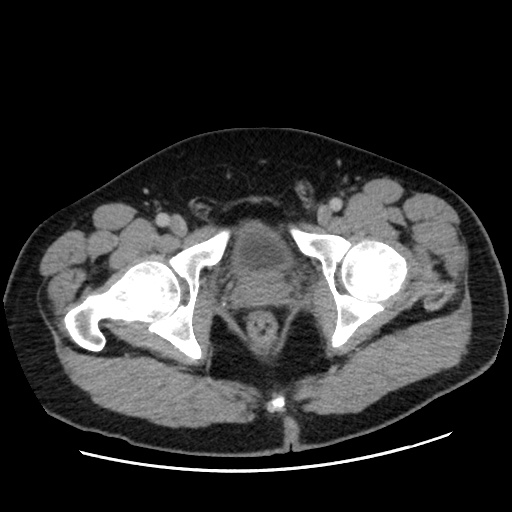 File:Acute diverticulitis with localized perforation (Radiopaedia 41296-44113 Axial C+ portal venous phase 89).jpg