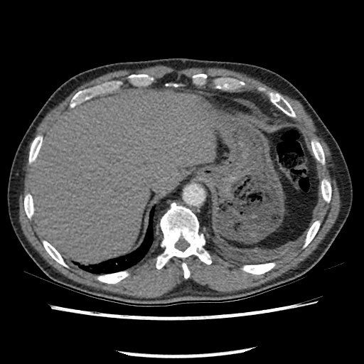 Acute epicardial fat necrosis (Radiopaedia 42327-45440 Axial C+ CTPA 81).jpg