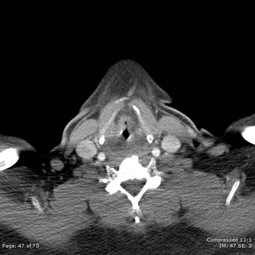 Acute epiglottitis (Radiopaedia 54375-60590 Axial C+ arterial phase 47).jpg