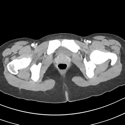 Acute gangrenous appendicitis with perforation (Radiopaedia 40152-42662 Axial C+ portal venous phase 76).png