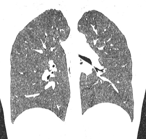 Acute hypersensitivity pneumonitis (Radiopaedia 85293-100870 Coronal lung window 80).jpg