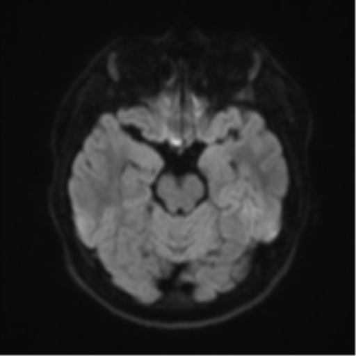 Acute left middle cerebral artery territory infarct with clot retrieval (Radiopaedia 47732-52433 Axial DWI 41).png