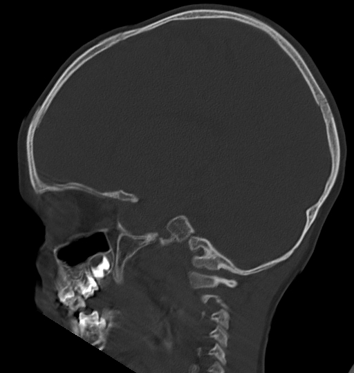 Acute mastoiditis (Radiopaedia 82678-96881 Sagittal bone window 40).jpg