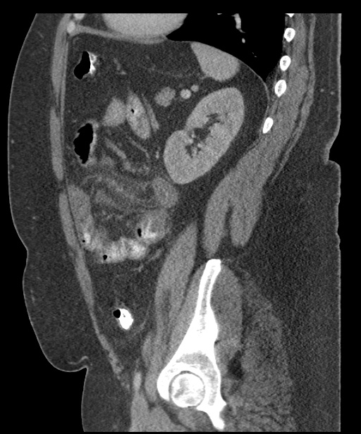 Acute mesenteric venous ischemia (Radiopaedia 46041-50383 Sagittal C+ portal venous phase 82).jpg