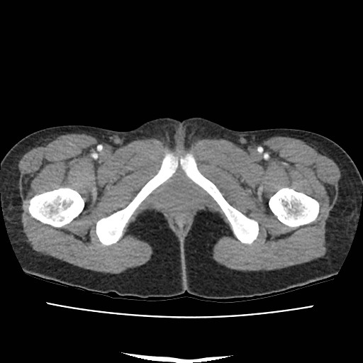 Acute myocarditis (Radiopaedia 55988-62613 Axial C+ portal venous phase 86).jpg