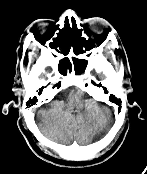 Acute on chronic subdural hematoma (Radiopaedia 78346-90966 Axial non-contrast 19).jpg