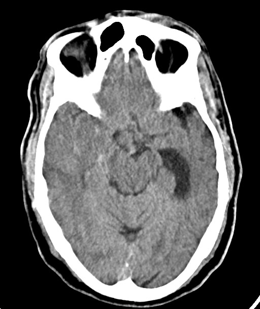 Acute on chronic subdural hematoma (Radiopaedia 78346-90966 Axial non-contrast 27).jpg