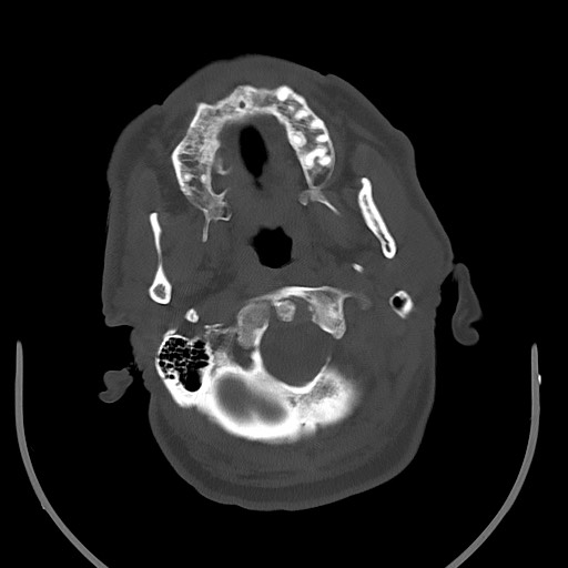 Acute on chronic subdural hematoma (Radiopaedia 78346-90966 D 15).jpg