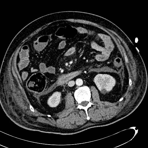 File:Acute pancreatic necrosis (Radiopaedia 13560-13486 Axial C+ portal venous phase 80).jpg