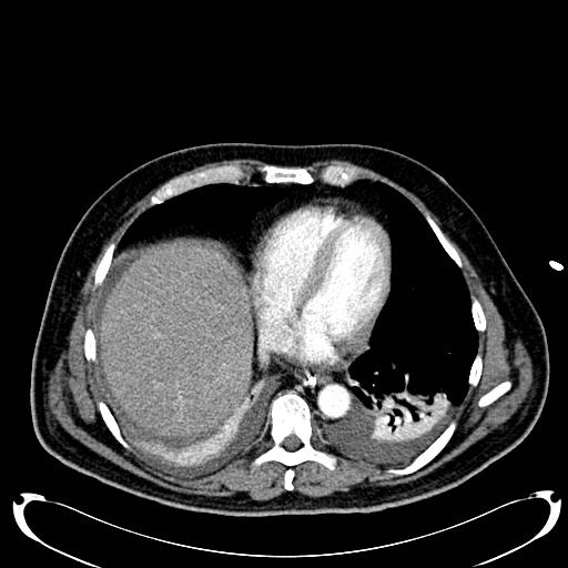 Acute pancreatic necrosis (Radiopaedia 13560-18500 Axial C+ portal venous phase 16).jpg