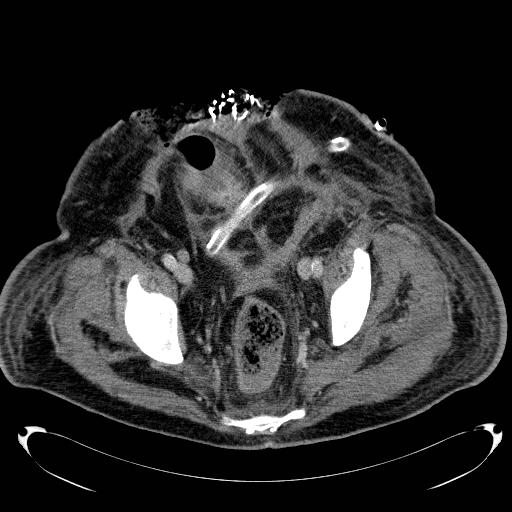 Acute pancreatic necrosis (Radiopaedia 13560-18503 Axial C+ portal venous phase 72).jpg