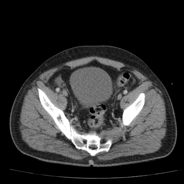 Acute pancreatitis (Radiopaedia 26663-26813 Axial C+ portal venous phase 73).jpg