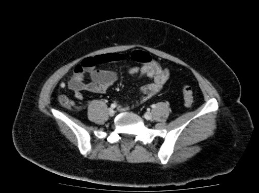 Acute pancreatitis (Radiopaedia 69236-79012 Axial C+ portal venous phase 66).jpg