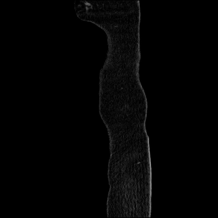 Acute pancreatitis (Radiopaedia 69236-79012 Sagittal C+ portal venous phase 95).jpg