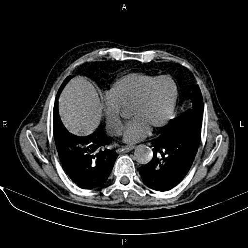 Acute pancreatitis (Radiopaedia 85146-100701 Axial non-contrast 13).jpg