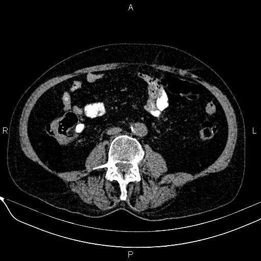 Acute pancreatitis (Radiopaedia 85146-100701 Axial non-contrast 73).jpg