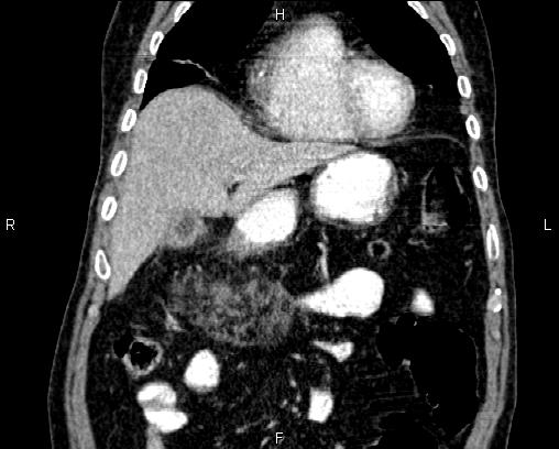 Acute pancreatitis (Radiopaedia 85146-100701 Coronal C+ portal venous phase 18).jpg