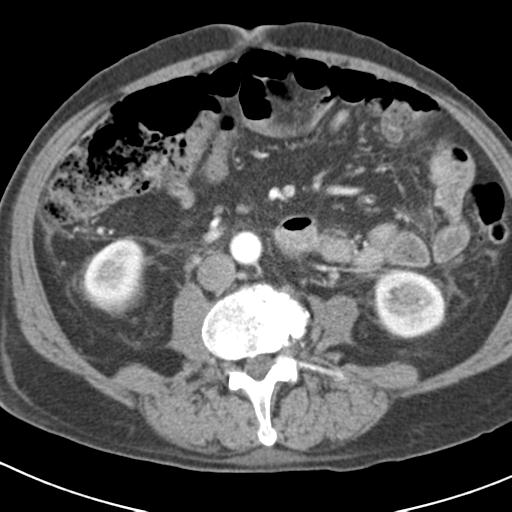 File:Acute pancreatitis and walled-off necrosis (Radiopaedia 29888-30403 Axial C+ portal venous phase 31).jpg