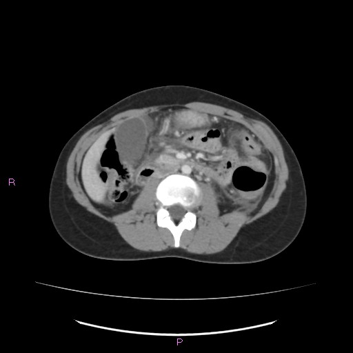 Acute pancreatitis secondary to stone at minor papilla and pancreatic divisum (Radiopaedia 76570-88333 Axial C+ portal venous phase 37).jpg