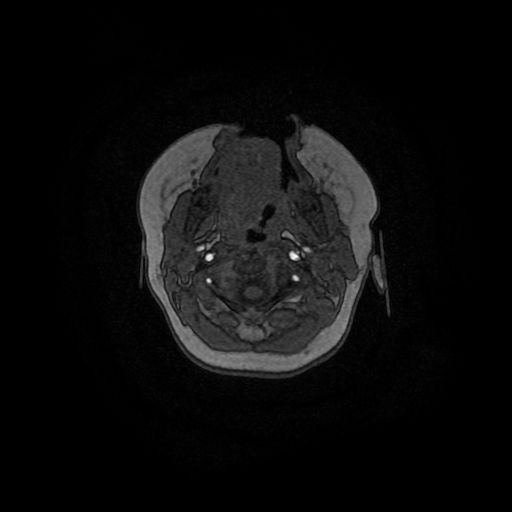 Acute phase of hemiconvulsion-hemiplegia epilepsy syndrome (Radiopaedia 29309-29745 Axial TOF angiography 169).jpg