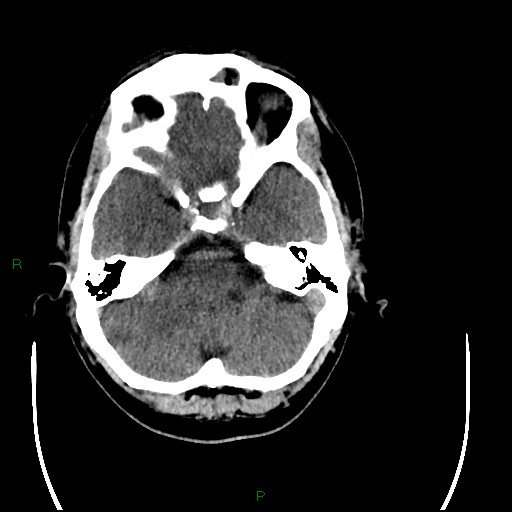 Acute posterior cerebral artery territory infarct (Radiopaedia 79329-92393 Axial non-contrast 26).jpg