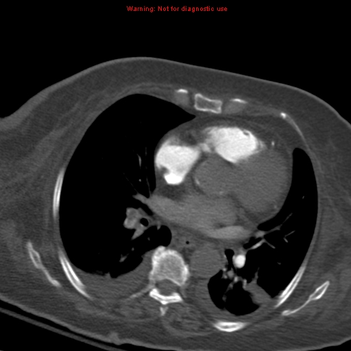 Acute pulmonary embolism (Radiopaedia 13286-13289 Axial C+ CTPA 37).jpg
