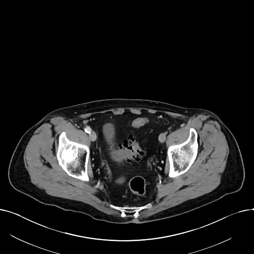 Acute renal infarction (Radiopaedia 59375-66736 Axial C+ portal venous phase 102).jpg