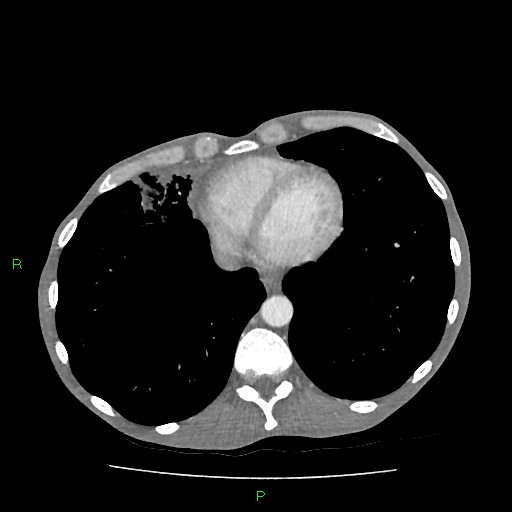 File:Acute right lung abscess (Radiopaedia 34806-36258 Axial C+ arterial phase 141).jpg
