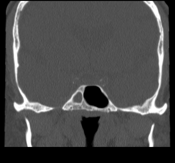 File:Acute sinusitis (Radiopaedia 23161-23215 Coronal bone window 53).jpg