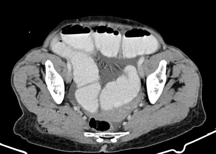 Acute small bowel (ileal) volvulus (Radiopaedia 71740-82139 Axial C+ portal venous phase 169).jpg