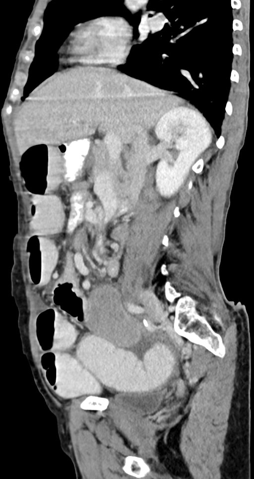 Acute small bowel (ileal) volvulus (Radiopaedia 71740-82139 Sagittal C+ portal venous phase 103).jpg