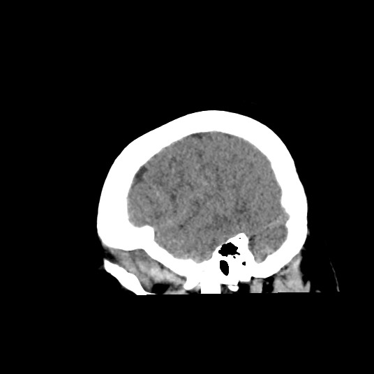 Acute subarachnoid hemorrhage and accessory anterior cerebral artery (Radiopaedia 69231-79008 Sagittal non-contrast 12).jpg