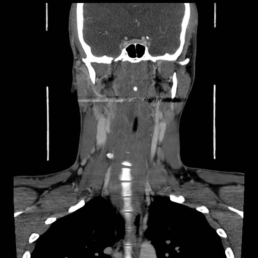 File:Acute submandibular sialadenitis secondary to ductal stone (Radiopaedia 27999-28267 D 32).jpg
