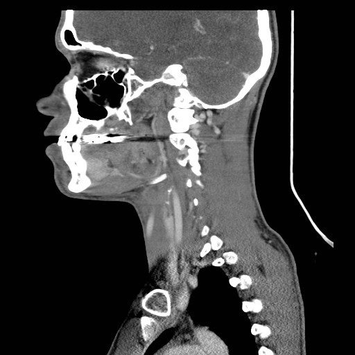 File:Acute submandibular sialadenitis secondary to ductal stone (Radiopaedia 27999-28267 Sagittal C+ delayed 29).jpg