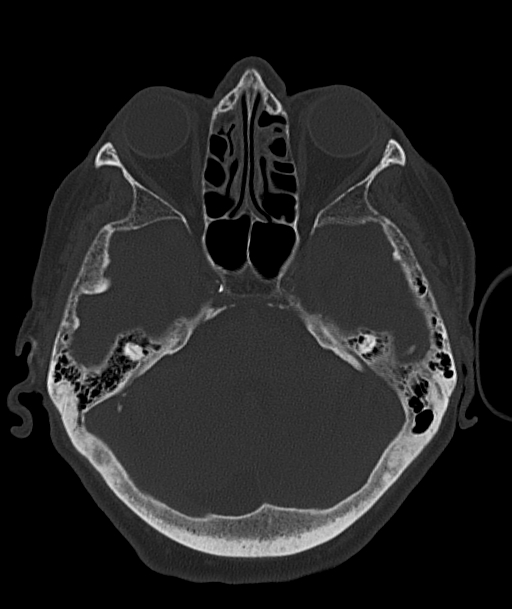 Acute traumatic subdural hematoma (Radiopaedia 82921-97257 Axial bone window 76).jpg