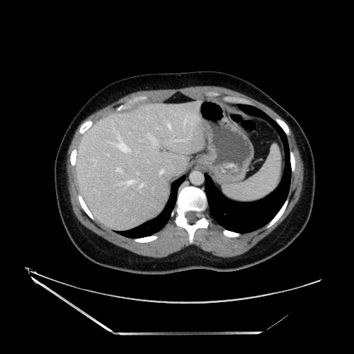 File:Acute uncomplicated appendicitis (Radiopaedia 73704-84499 Axial C+ portal venous phase 28).jpg