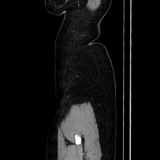 Acute uncomplicated appendicitis (Radiopaedia 73704-84499 Sagittal C+ portal venous phase 41).jpg