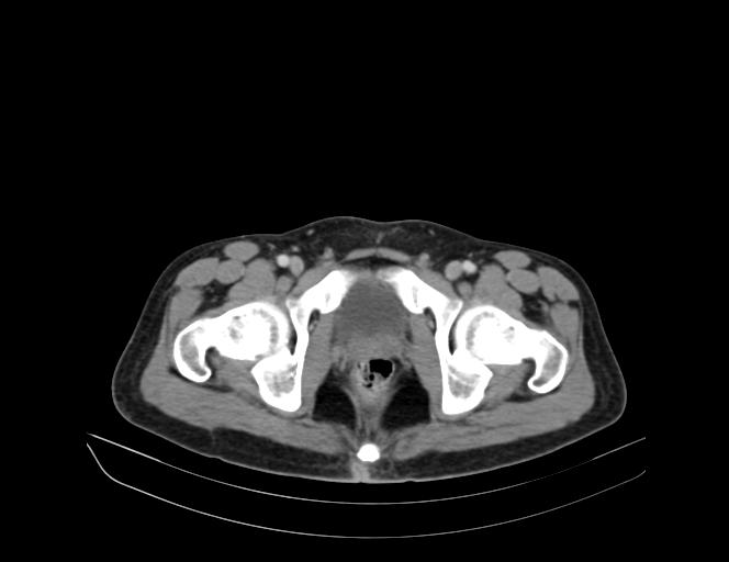 Addison disease (Radiopaedia 49318-54412 Axial C+ portal venous phase 74).jpg
