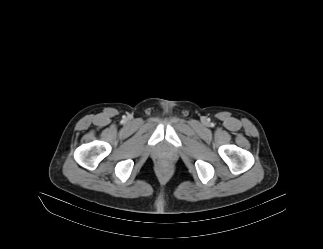Addison disease (Radiopaedia 49318-54412 Axial C+ portal venous phase 77).jpg