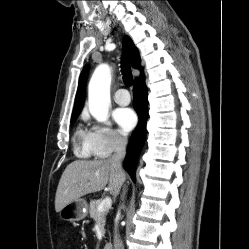 Adenocarcinoma of the lung (Radiopaedia 59871-67325 Sagittal C+ arterial phase 48).jpg