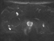 Adenocarcioma of rectum- T1 lesion (Radiopaedia 36921-38546 Axial DWI 38).png