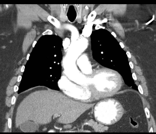 Adenocarcioma of rectum- T1 lesion (Radiopaedia 36921-38547 Coronal C+ arterial phase 26).png