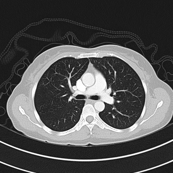 Adenocystic carcinoma of the trachea (Radiopaedia 47677-52525 Axial lung window 48).jpg