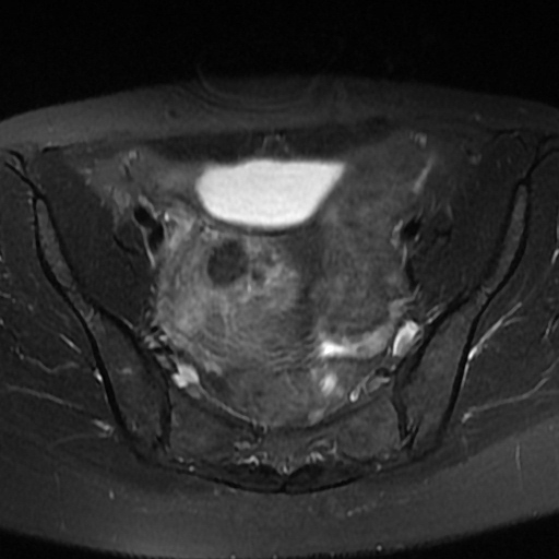File:Adenoma malignum of cervix (Radiopaedia 66441-75705 Axial T2 fat sat 2).jpg