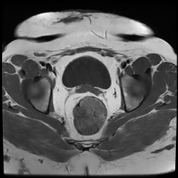 File:Adenomyosis within a didelphys uterus (Radiopaedia 70175-80215 Axial T1 30).jpg